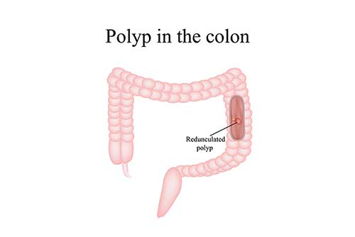 polyps in  the colon
