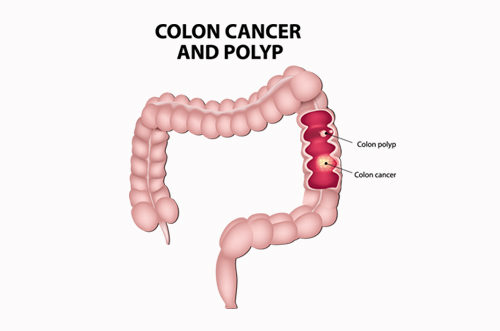 Colonic polyp to develop into cancer