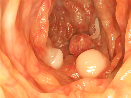 What are colonic polyps